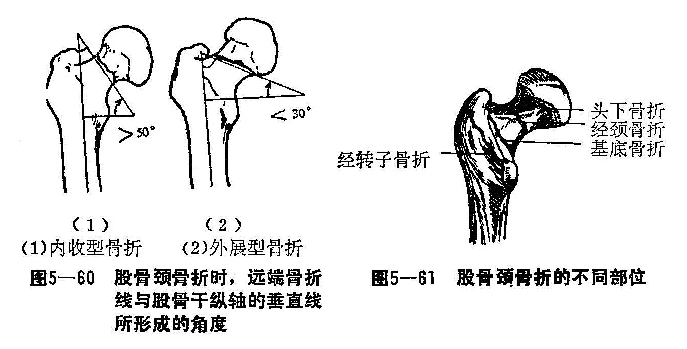 三、股骨颈骨折